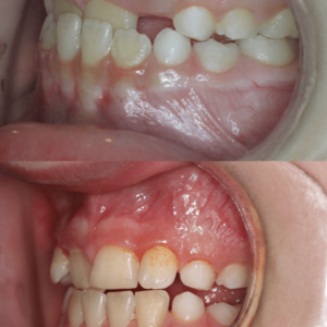 Bandeen Orthodontics Case Studies Early Treatment