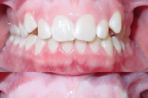 Case Study 62 – Gummy Smile