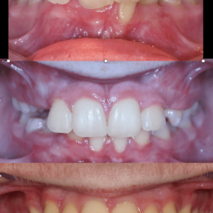 Bandeen Orthodontics Case Studies Early Treatm