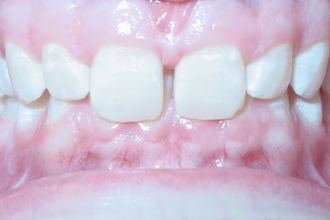 Case Study 71 – Spacing between teeth