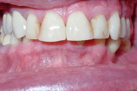 Case Study 80 – Deep bite with multiple molars and premolars missing