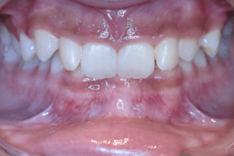 Case Study 82 – Missing a lower incisor, and camouflaged the absence of both with moving the other teeth forward