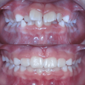 Bandeen Orthodontics Case Studies Early Treatmen