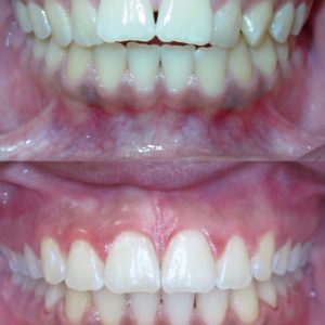 Bandeen Orthodontics Case Studies Full TreatmentBandeen Orthodontics Case Studies Full Treatment