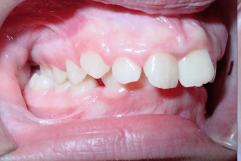 Case Study 75 – Canines impacted due to early loss of baby teeth