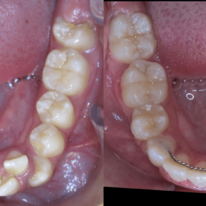 Bandeen Orthodontics Case Studies Full Treatment