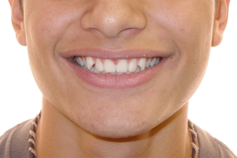 Case Study 4 – Orthodontic Class II
