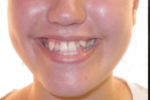 Case Study 8 – Orthodontic Class III