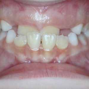 Bandeen Orthodontics Case Studies Early Treatment