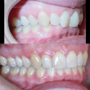 BandeenOrthodontics Case Studies Full Treatment