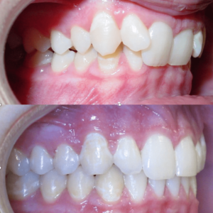 Bandeen Orthodontics Case Studies Full Treatment